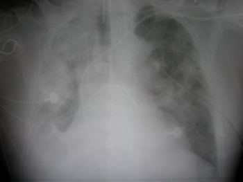 Bilateral pulmonary contusions