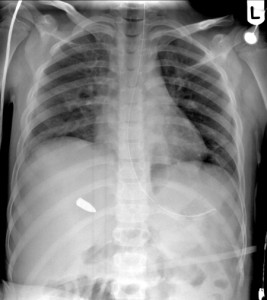 Incidental bullet on chest xray